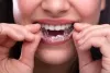 invisible teeth aligners