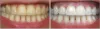 Cost of Teeth Cleaning in Delhi, South Delhi, Greater Kailash