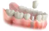 Dental Implants in Chennai | Implantologist in Chennai