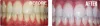 Teeth Whitening in Delhi NCR, Teeth bleaching in Gurgaon