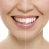 laser teeth whitening houston tx