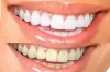 Best Teeth Whitening Strips in Dubai 