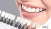 Teeth Whitening Calgary SE – Top-notch Dental Care for a Great Smile – smile32dentistry