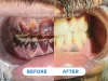 Top Laser Teeth Whitening Treatment in Kolkata | Teeth Bleaching