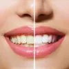 teeth whitening in dombivli