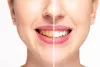 Teeth Whitening: DIY vs. Professional Treatments Explained