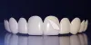 Teeth Whitening in Delhi | Teeth Whitening Treatment in Dwarka