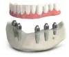 Dental Implants in The Woodlands,Conroe, TX | PCE