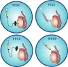 tesa treatment in delhi	