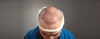 The Real Cost of a Hair Transplant in India