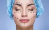 Face Lift Surgery Procedure in Delhi