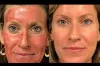 Sink Your Teeth into Glamour: Exploring Vampire Facials in Dubai