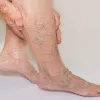 How can you find a perfect vein clinic doctor in New Jersey?