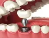 Why Does Someone Require Dental Veneers?