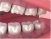What To Expect During Deep Teeth Cleaning At Office?