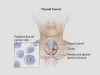 Thyroid Cancer Symptoms