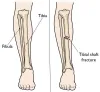 Treatment of The Fractures of The Tibia - Exactarticle : Exactarticle