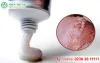  [Đà Nẵng] Tìm hiểu về thuốc bôi chữa sùi mào gà tốt nhất hiện nay 