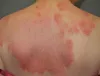 Healthy Skin