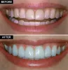 What Is The Difference Between Composite Veneers And Composite Bonding?