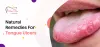 Natural Remedies for Tongue Ulcers