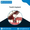 Tooth Implant | All on four | Denture | Montclair CA