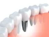 Dental Implants Plano TX | Plano Dental Implants - Plano Dentist | Cosmetic Dentist & Dental Implants Plano TX