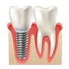 Check Dental Implants Cost in Bangalore | House of Dentistry