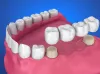 Root Canal Treatment