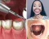 Reasons to Visit a Dental Implant Clinic - Smilessence