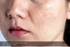 Treat and Fade Your Pigmentation - Ingredients to Look For