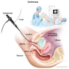 Gestational Trophoblastic Disease