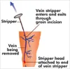 Best  of Varicose vein treatment in Pune  at Karishma vein clinic 
