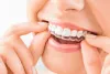 Trends in Invisalign Invisible Braces