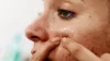 Acne Worse