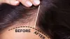 Hair Transplant