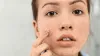 Stress-Related Acne 