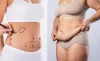 Tummy Tuck or Liposuction – Which One Do I Need?