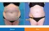 tummy-tuck2.jpg