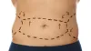 Tummy Tuck(Abdominoplasty) Surgery in Delhi | Best Cost in Delhi