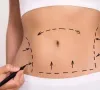 Tummy Tuck Cosmetic Surgery 