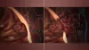 Benign Tumor Symptoms