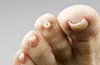 Uñas enterradas: problema más que estético al cual atender