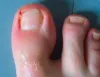 ¿Uñas enterradas? Evítalo visitando a los mejores del sector