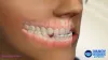 bracesbeforeandafterblog [licensed for non-commercial use only] / Teeth-Correction