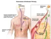 Unknown primary tumor cancer