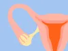 Poor Ovarian Reserve and Infertility - What Need to Know