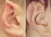 Cosmetic Ear Surgery Pin Back Your Ears - WriteUpCafe.com