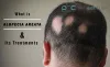Alopecia Areata Treatment: How Alopecia Areata can be cured?