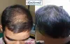 #1 Best LLLT Treatment for Hairfall in Durgapur